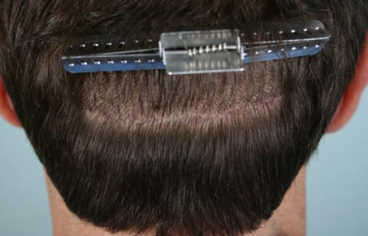 Hair Transplant&nbsp;Trichophytic Donor Scars